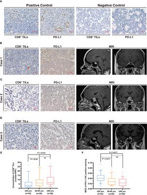 PD-L1 and tumor-infiltrating CD8+ lymphocytes are correlated with clinical characteristics in pediatric and adolescent pituitary adenomas